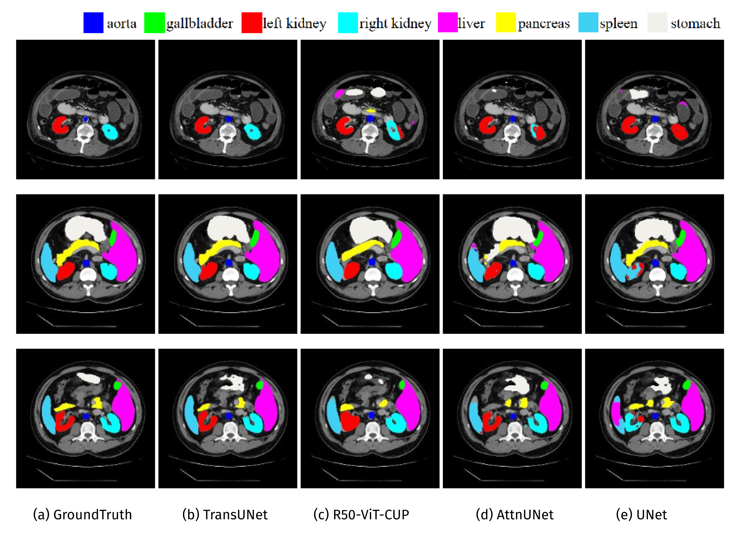 Qualitative comparison of different approaches by visualization. (a) Ground Truth, (b) TransUNet, (c) R50-ViT-CUP, (d) R50-AttnUNet, (e) R50-U-Net